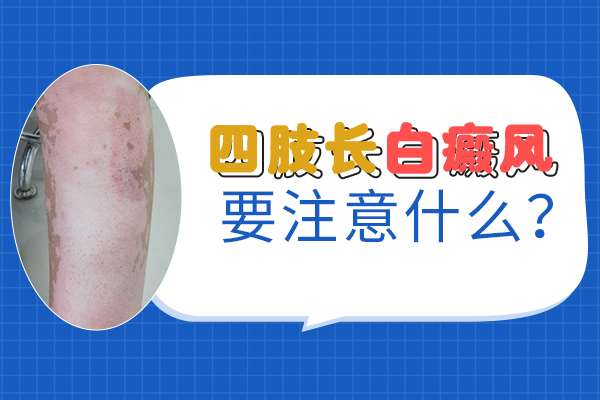 绍兴专科白癜风医院 青少年白斑的症状有什么特征