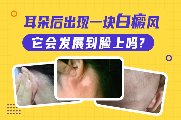 杭州市白癜风医院 女性患上白癜风应该怎么治疗